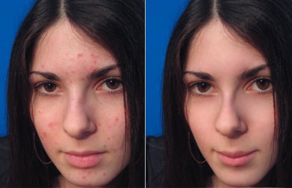 I will remove acne or scars from your face with Photoshop