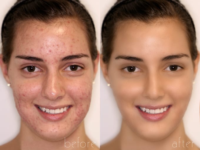 I will make your face clean if pimples or spots screwed your photo