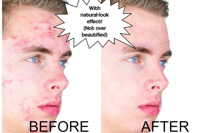 I will remove acne scars mustache etc using photoshop