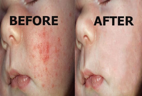 I will remove spots, pimples and change red colour of your eyes