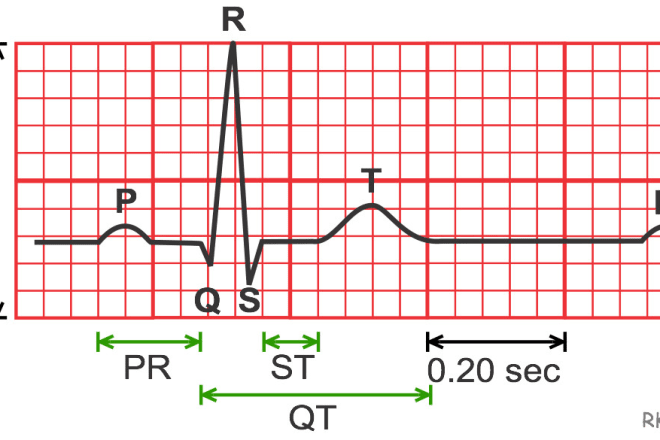 I will write ecg report for you