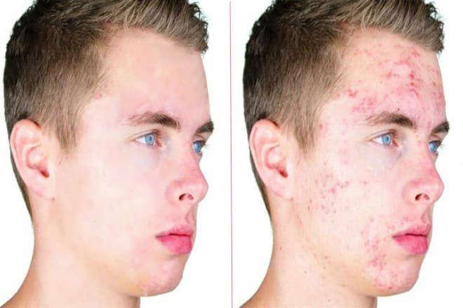 I will if you want to get rid of acne, you are in the right place