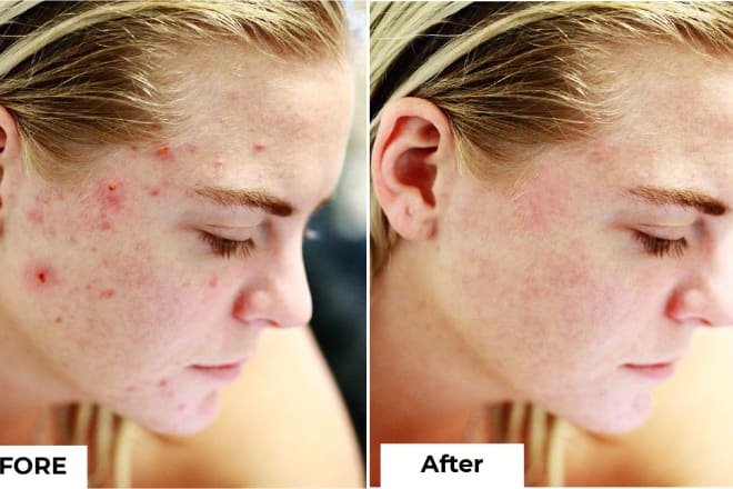 I will do skin retouching and acne or pimple removal on photoshop